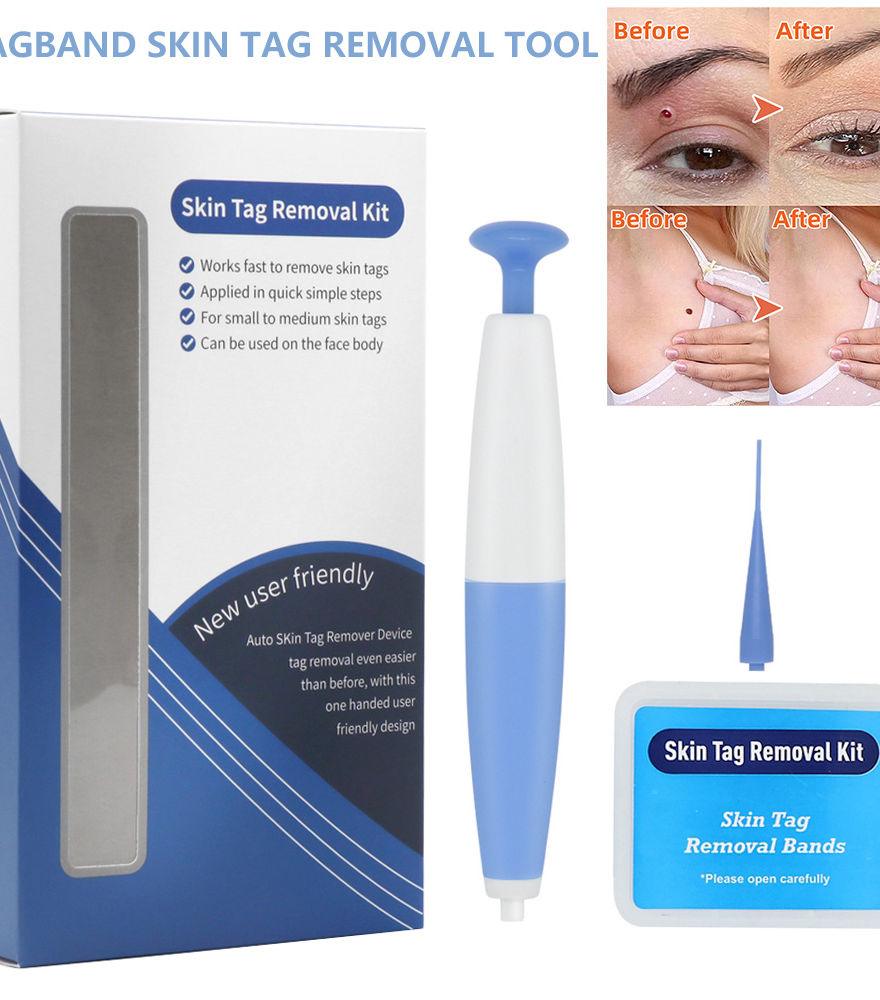 Skin Tag Removal Kit - CentralFlows