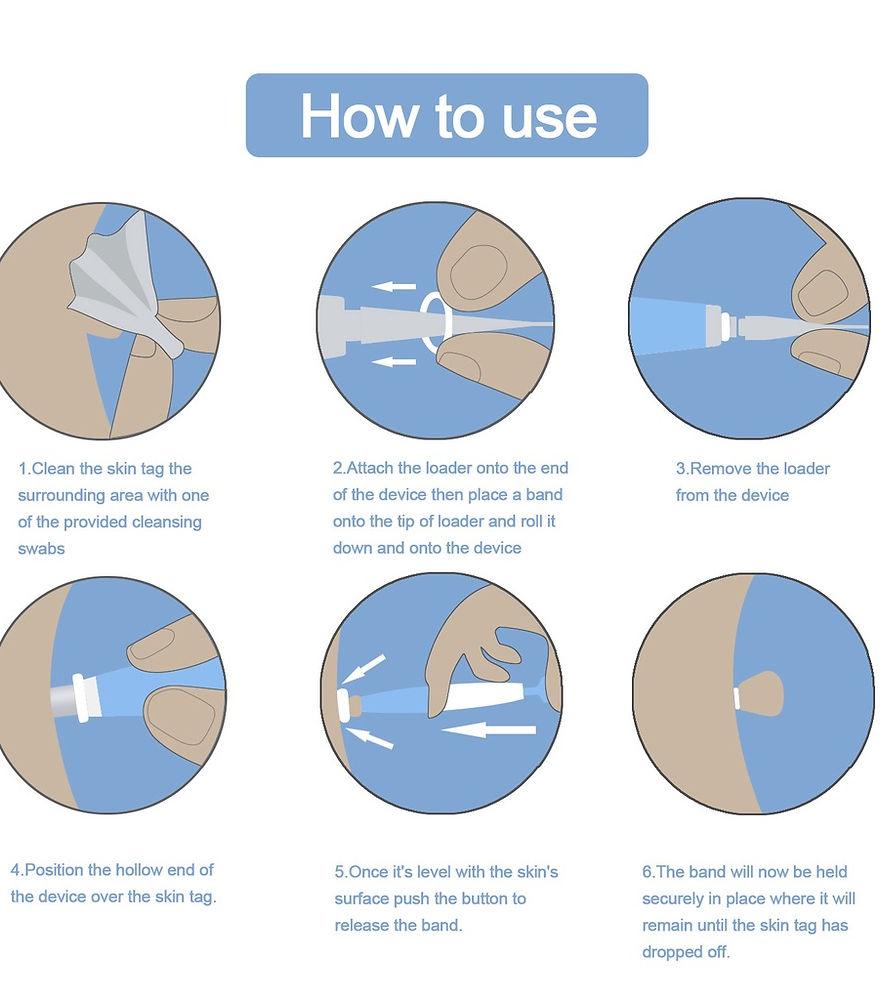 Skin Tag Removal Kit - CentralFlows