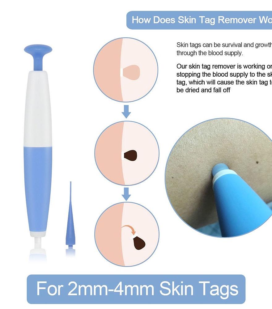 Skin Tag Removal Kit - CentralFlows